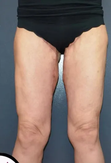 Thigh Lift