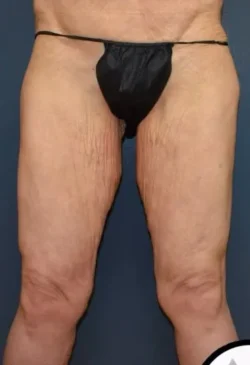 Thigh Lift