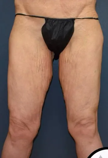 Thigh Lift