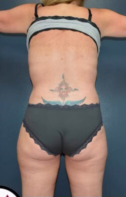 Abdominoplasty