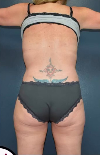 Abdominoplasty