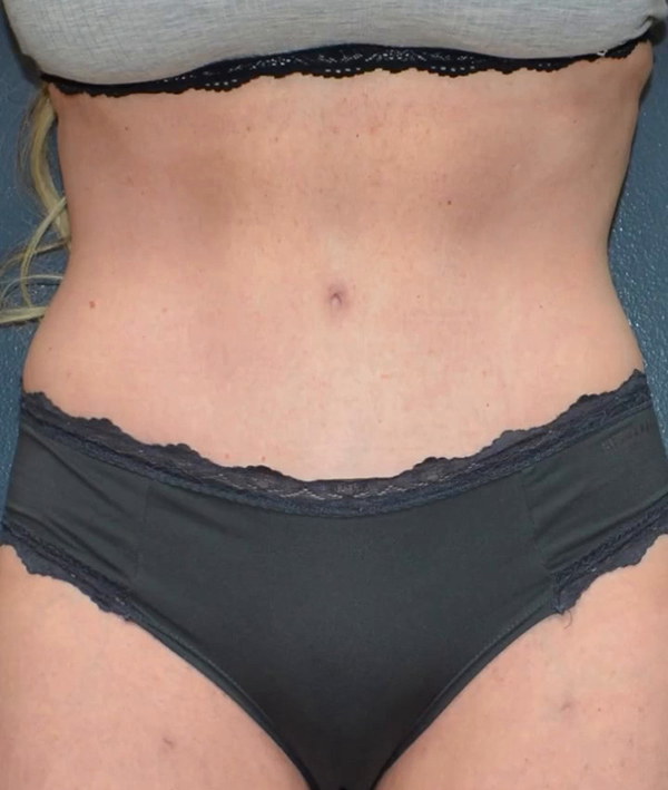 Abdominoplasty