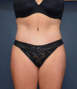 Abdominoplasty