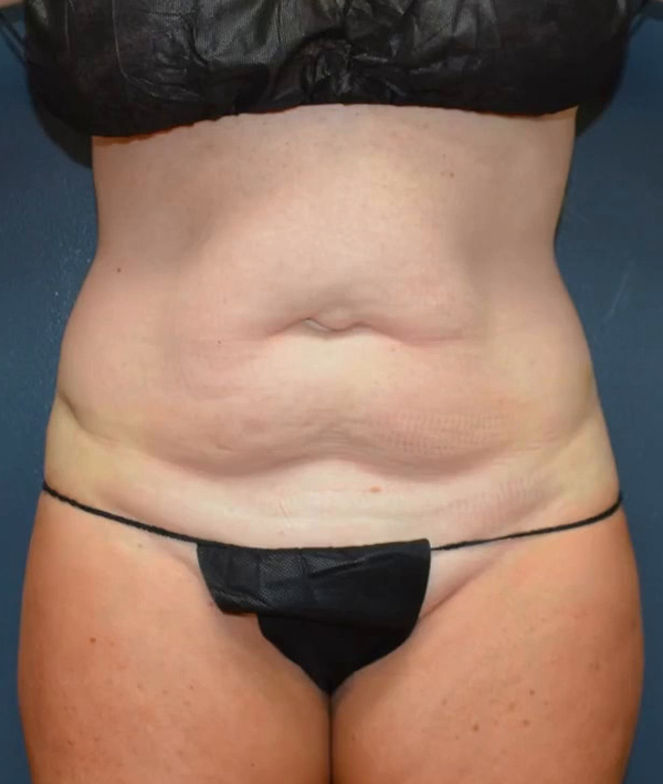Abdominoplasty