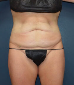 Abdominoplasty