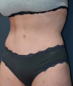 Abdominoplasty