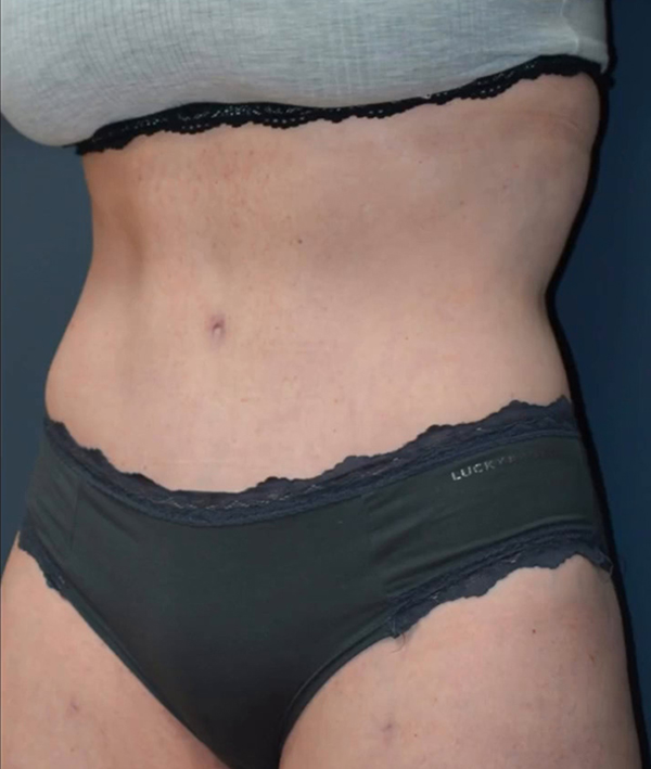 Abdominoplasty