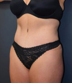 Abdominoplasty