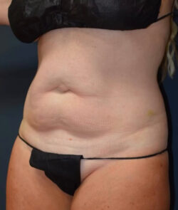 Abdominoplasty
