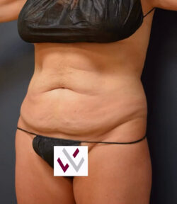 Abdominoplasty