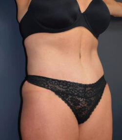 Abdominoplasty
