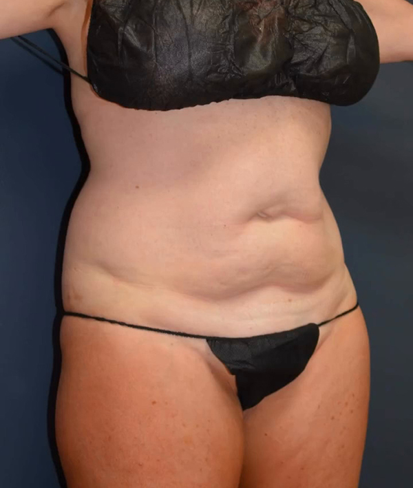 Abdominoplasty