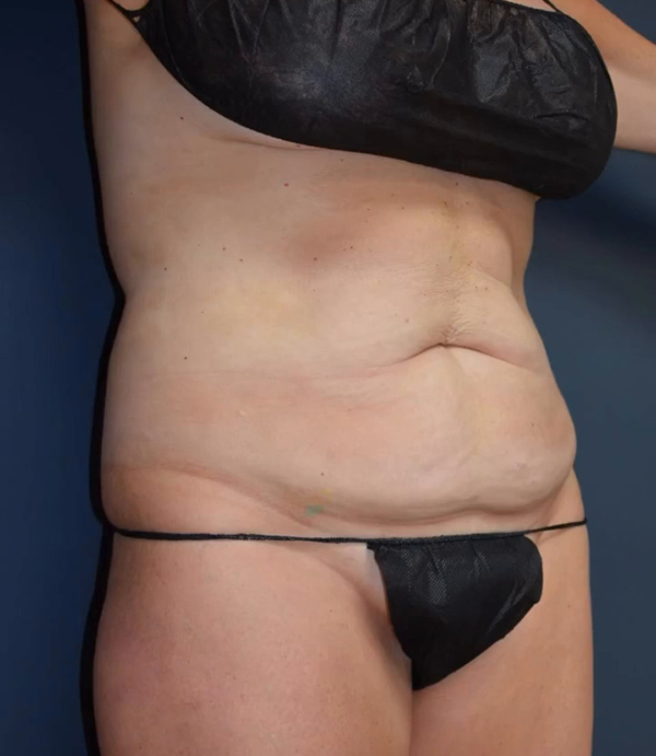 Abdominoplasty
