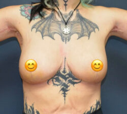 Breast Lift
