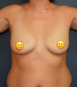 Breast Augmentation