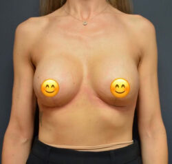 Breast Revision