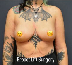 Breast Lift
