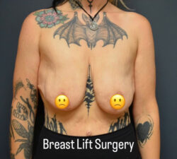 Breast Lift