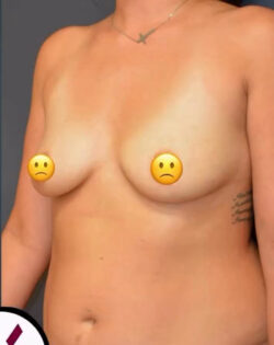 Breast Augmentation