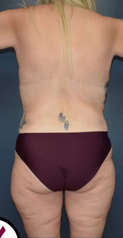Abdominoplasty