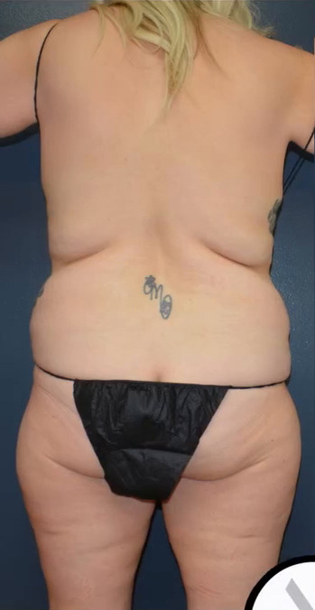Abdominoplasty