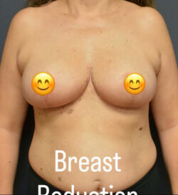 Breast Reduction
