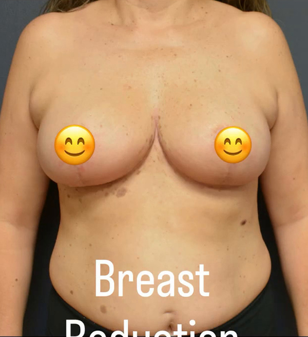 Breast Reduction
