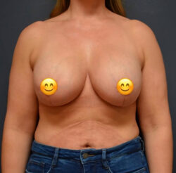 Breast Revision