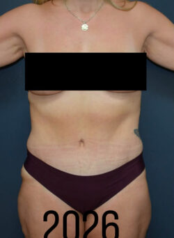 Abdominoplasty
