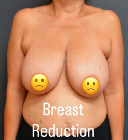 Breast Reduction