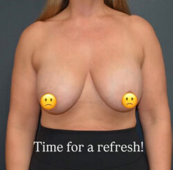 Breast Revision