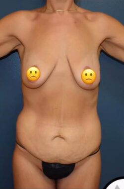 Abdominoplasty