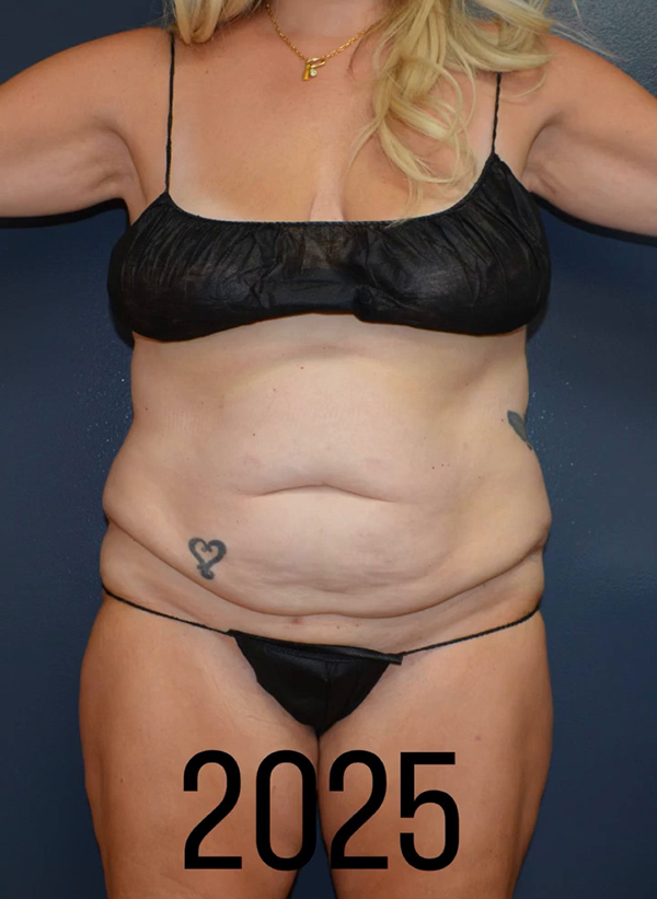 Abdominoplasty