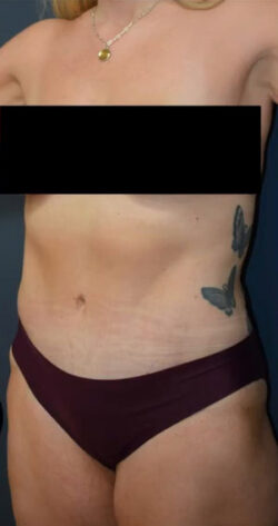 Abdominoplasty