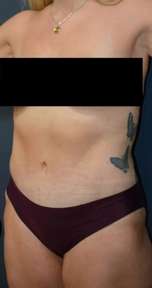 Abdominoplasty