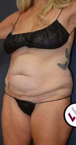 Abdominoplasty