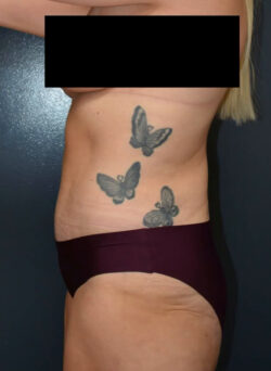 Abdominoplasty