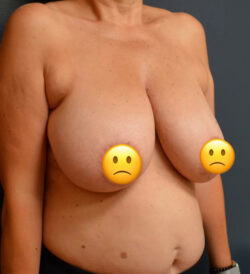 Breast Reduction