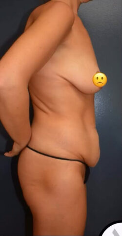 Abdominoplasty