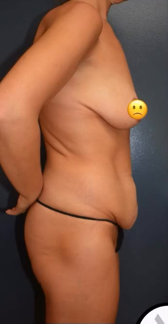 Abdominoplasty