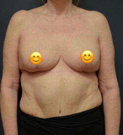 Breast Reduction