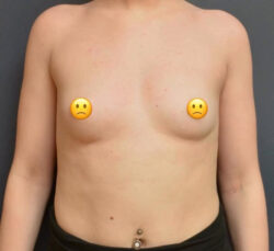 Breast Augmentation