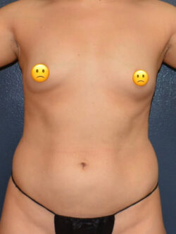 Breast Augmentation