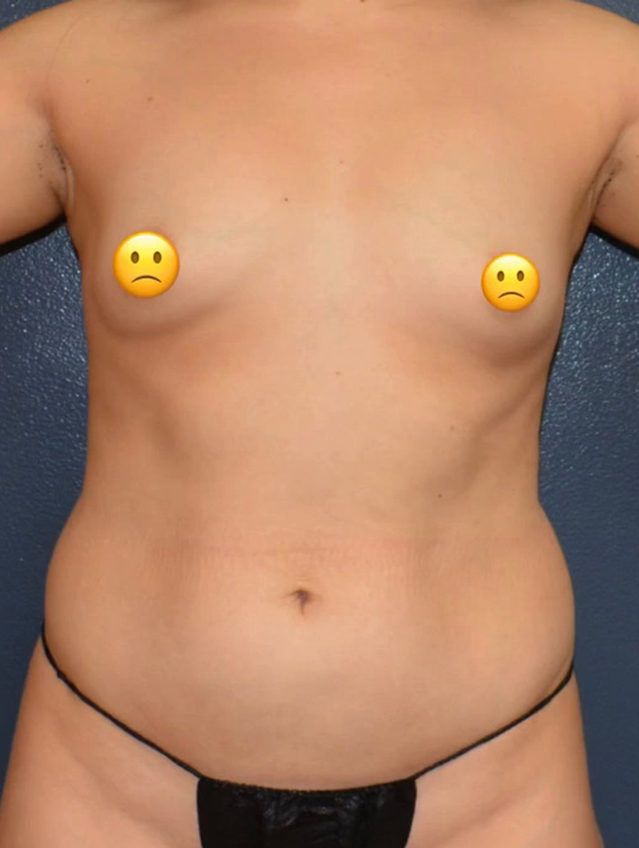 Breast Augmentation