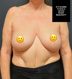Breast Reduction