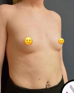 Breast Augmentation