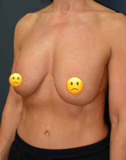 Breast Revision