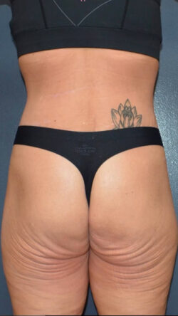 Lower Body Lift