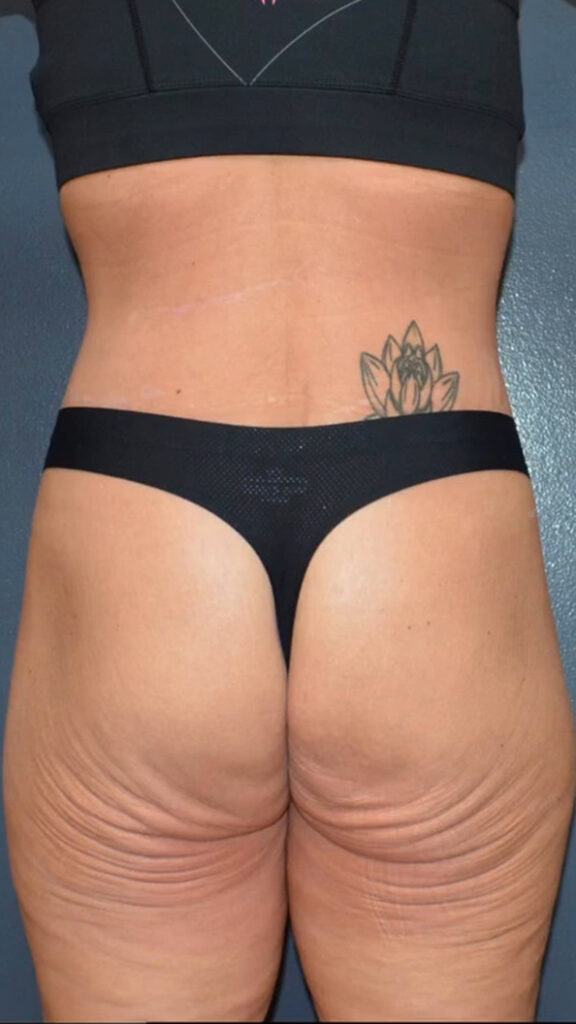 Lower Body Lift