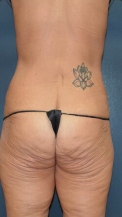 Lower Body Lift